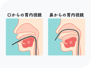 胃カメラは鼻から・口からを選択可能