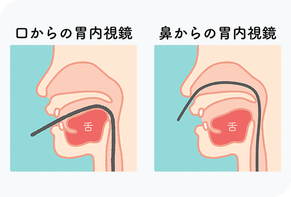 胃カメラは鼻から・口からを選択可能